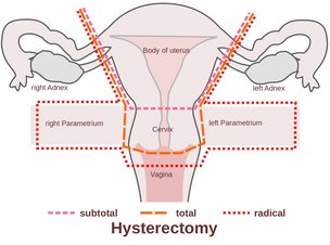 Diagram of hysterectomy types